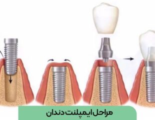 مراحل ایمپلنت دندان