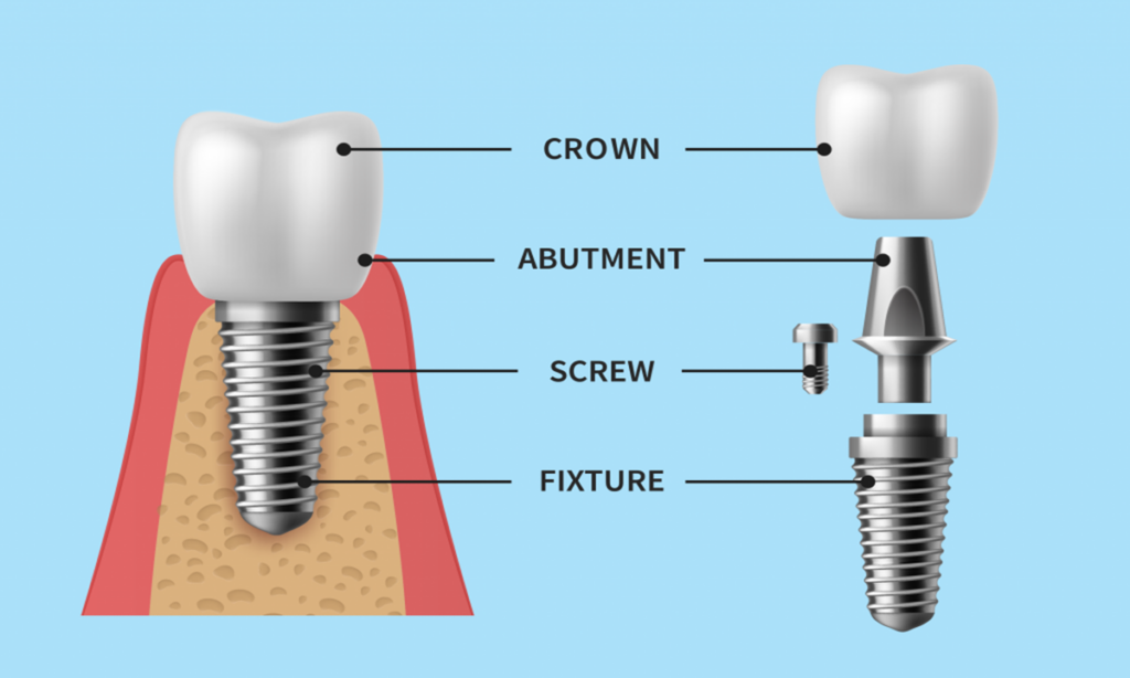 تصویری از اجزای ایمپلنت