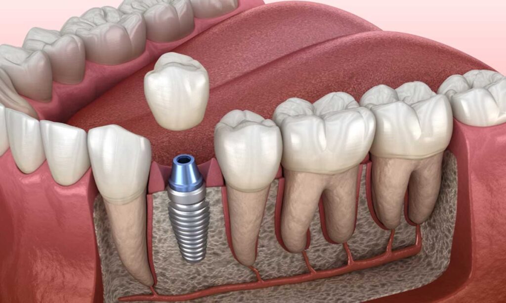 ایمپلنت دندان