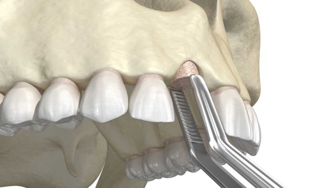 تحلیل استخوان فک