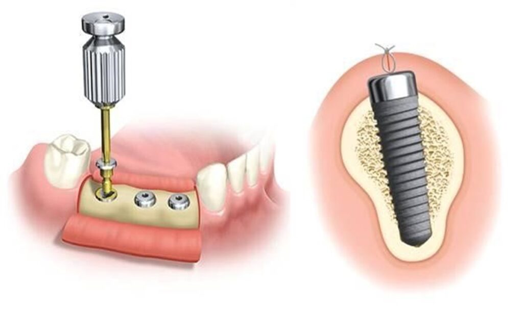 تصویری از نحوه ی جایگذاری هیلینگ ایمپلنت