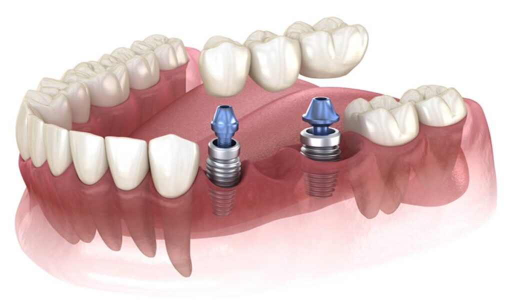 تصویری سه بعدی نشان دهنده استفاده از دو ایمپلنت برای چند دندان
