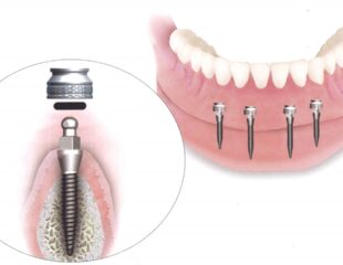 تصویری از مینی ایمپلنت دندان