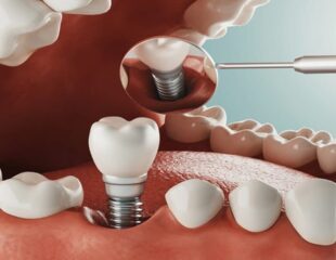 ایمپلنت دندان