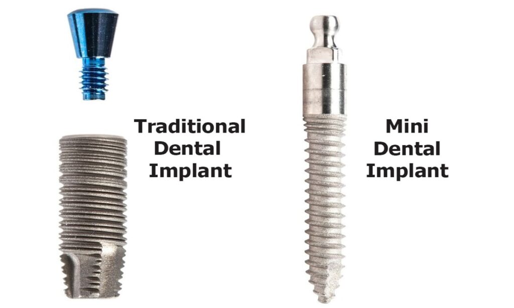 تصویر ایمپلنت معمولی و مینی ایمپلنت در کنار هم