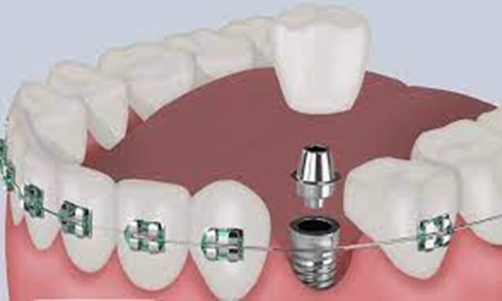 ارتودنسی دندان ایمپلنت شده