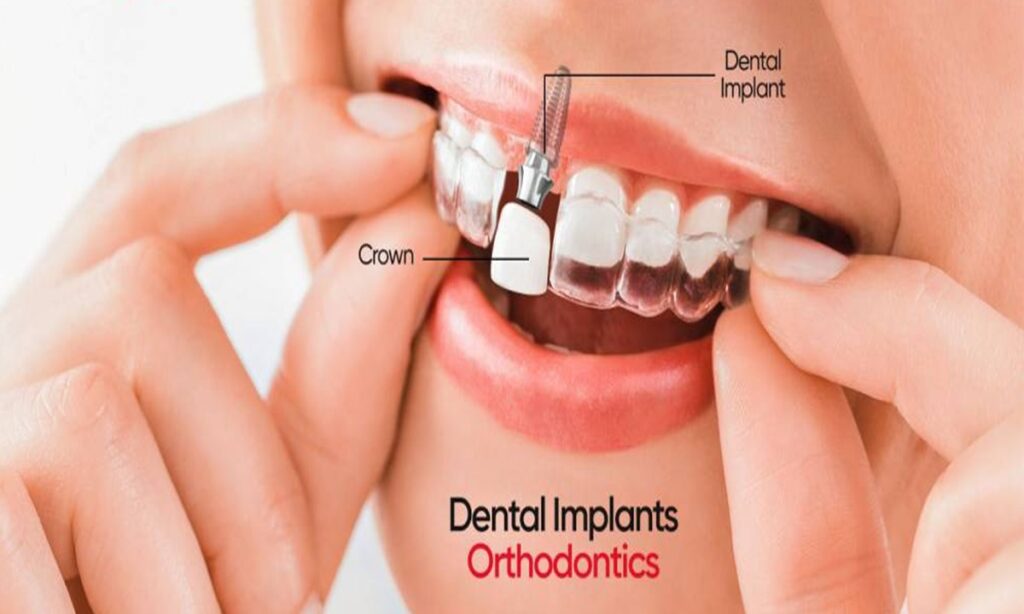 ارتودنسی دندان ایمپلنت شده