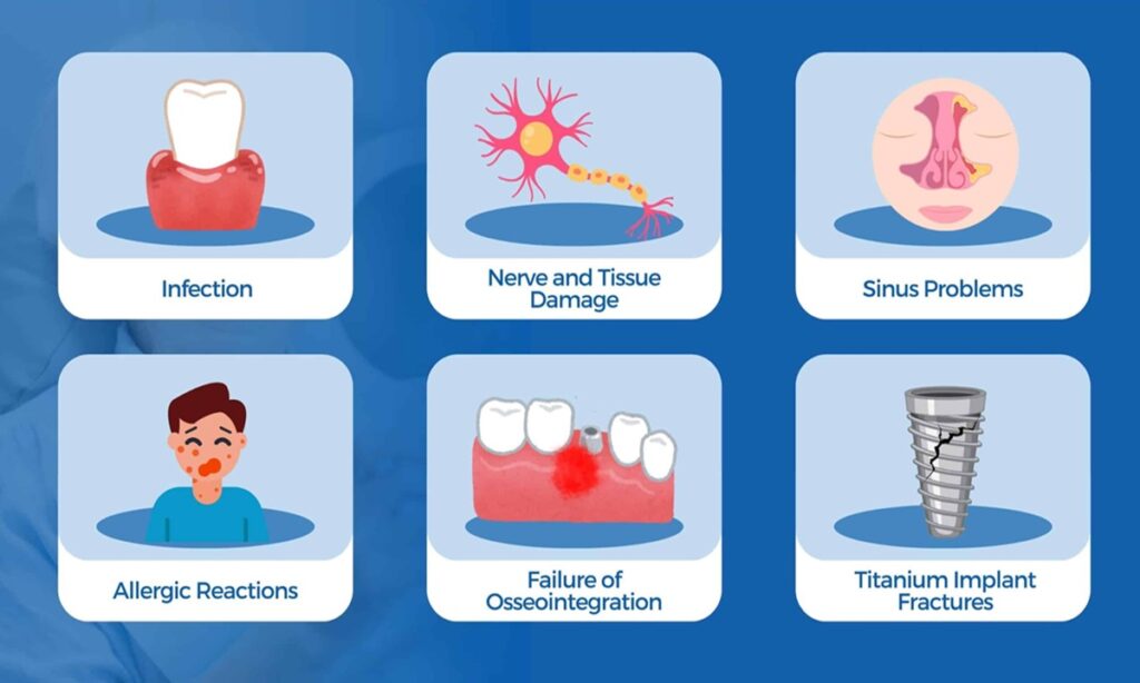 تصویر عوارض احتمالی حساسیت به ایمپلنت دندان