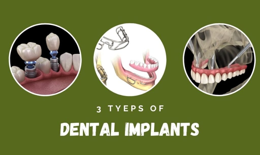 تصویر سه نوع مختلف ایمپلنت دندان