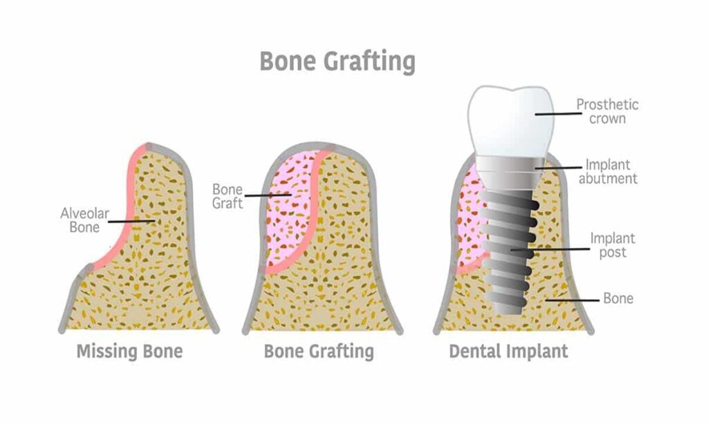 تصویری از مراحل پیوند استخوان برای ایمپلنت دندان